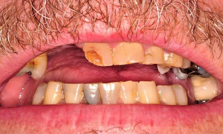 Close up of smile with chipped and missing front teeth before dental crowns and implants in Towson, MD