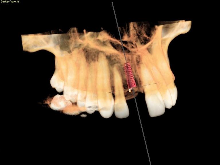 Screenshot of 3-D cone beam technology at dentist in Towson, MD